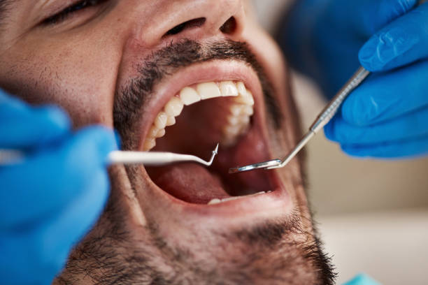 Best Dental Abscess Treatment in Wacousta, MI